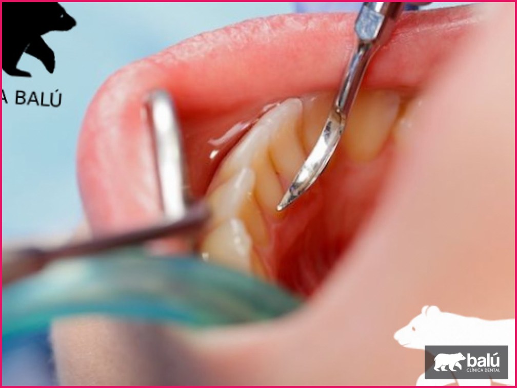 Curetaje dental: en qué consiste y cuándo se necesita