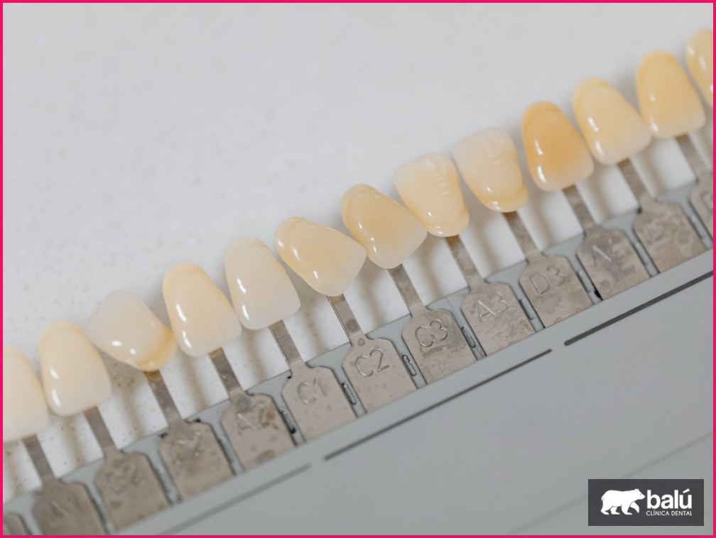 Cuánto duran las carillas dentales y cómo cuidarlas