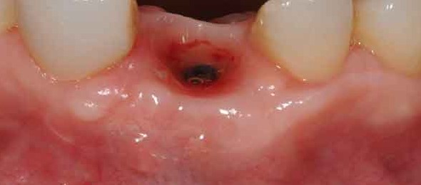 Alveolitis dental humeda