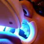 Blanqueamiento dental laser