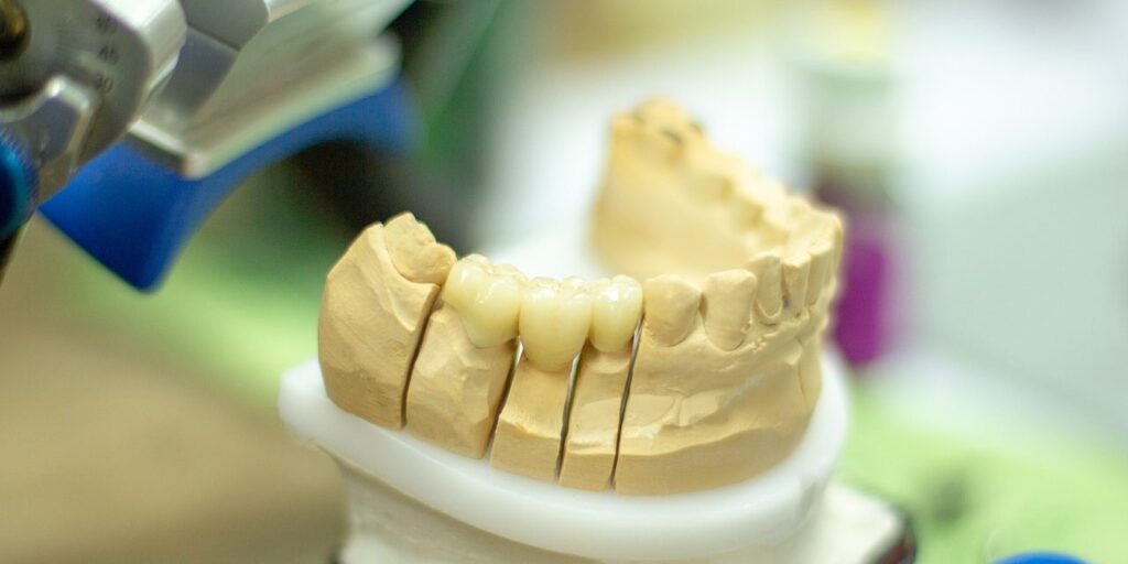 las alternativas a los implantes dentales.