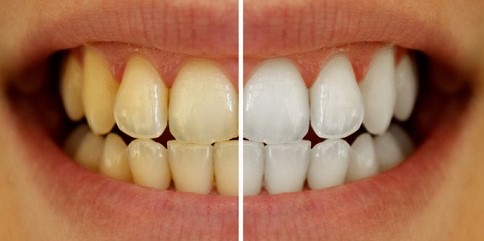 dientes color gris amarillento