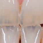 dientes translucidos