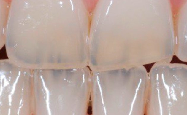 dientes translucidos
