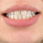 manchas blancas en los dientes