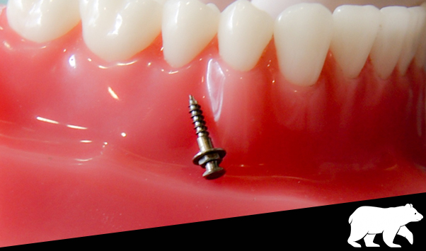Foto Mini implantes dentales