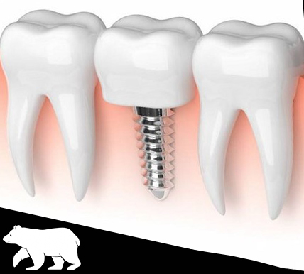 Mini implantes dentales