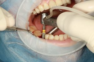 prótesis dental fija