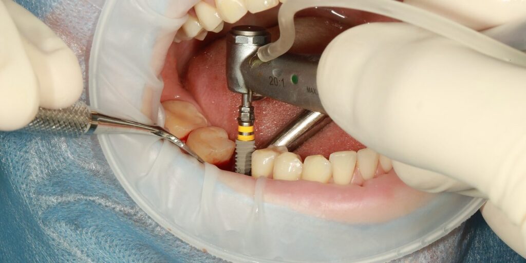 qué son los implantes dentales